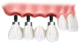 佛山种牙爆料事件最新,揭露行业乱象，患者权益如何保障？